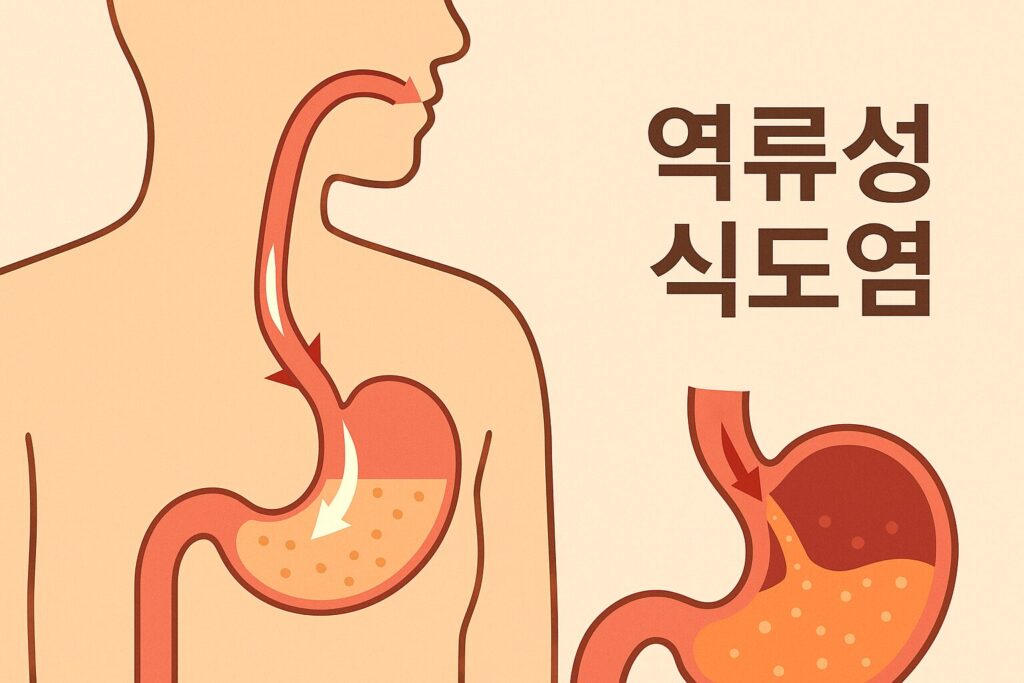 역류성 식도염 발생 과정 인포그래픽